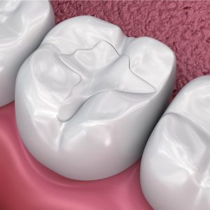 dental filling