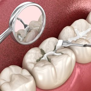 dental fillings