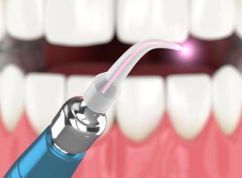 What is laser dentistry?