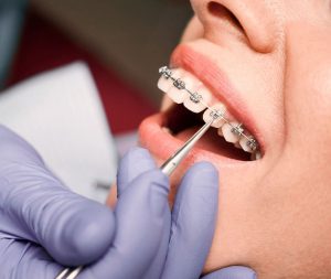 braces