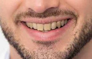 Close-up of a man's smile with discolored teeth, highlighting the need for professional teeth whitening services offered by Sweet Hart Dental in Pembroke Pines.