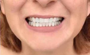 After treatment at Sweet Hart Dental in Pembroke Pines