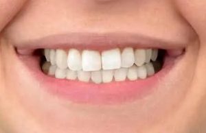 After treatment at Sweet Hart Dental in Pembroke Pines