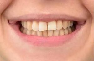 Before treatment at Sweet Hart Dental in Pembroke Pines