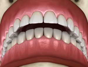 overbite