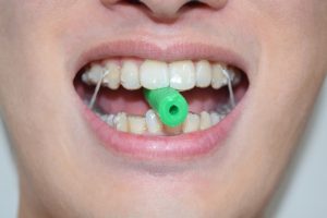 aligner chewies