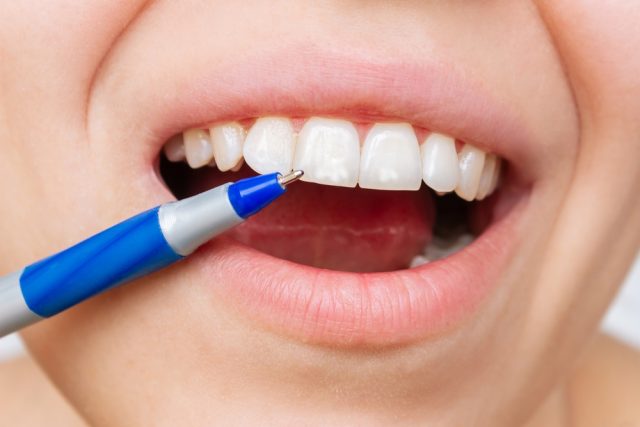 dental fluorosis, or calcium stains
