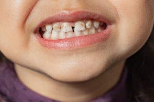 Close-up of a child's mouth showing teeth with white spots and discoloration, indicative of dental fluorosis or decalcification, relevant to discussions on calcium stains and dental health.