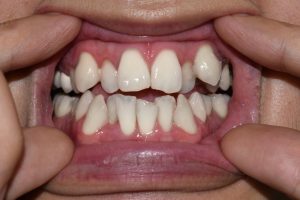 stacked, overlapping teeth