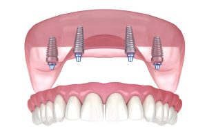 implant-supported denture