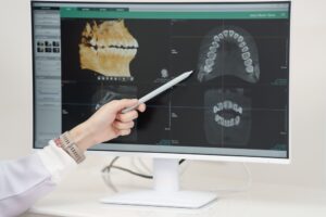 Dental professional pointing at digital dental X-rays on a monitor, illustrating detection of decay under restorations and the importance of timely dental assessments.