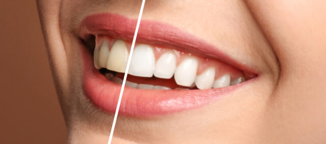 Close-up of a smiling woman showing a side-by-side comparison of teeth before and after a smile makeover, highlighting cosmetic dentistry results.